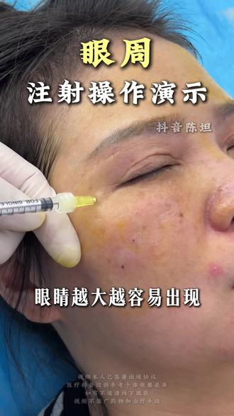 眼周年轻化 #广州陈坦 #注射 #眼周 #眼周年轻化 温馨提示:效果因人而异,肖像授权齐全。内容无医疗项目推广,所有出镜人员均已成年且年满25周岁。