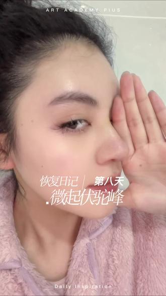 拆🧵啦~你们帮我看看好看吗 #微起伏 #鼻整形 #恢复记录