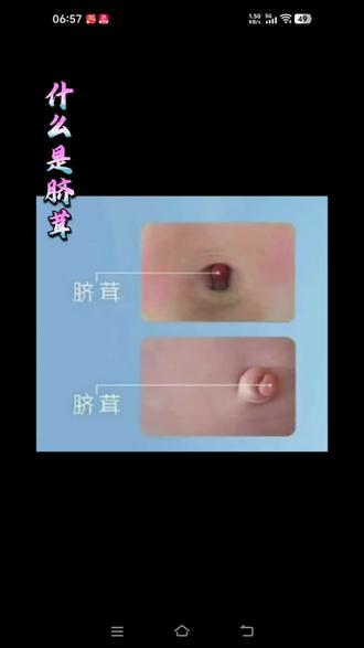 什么是脐茸,脐带里有3根管与宝宝相连,一根与大肠连通,一根与血管连通,一根与肝脏连通,当脐带脱离时我们护理人员会发现,最后有一根细细的还连着,在干燥一天左右就完全脱离了,随后有分泌物,护理人员还要继续消毒,直到没有分泌物了,就不用再消毒了,这些是脐部护理的正常现象。
图上的肚脐,医院专业术语叫脐茸,一般这种肚脐脱落的都晚些,原因是三根细管过早的封闭了,脐带掉落之前就长好了,导致分泌物排不出来,就长出了肉芽状的包。
这种情况跟护理人员无关,是宝宝自身结构造成的!这跟脐带消毒没有关系。
出现这种情况就要及时就医治疗。
