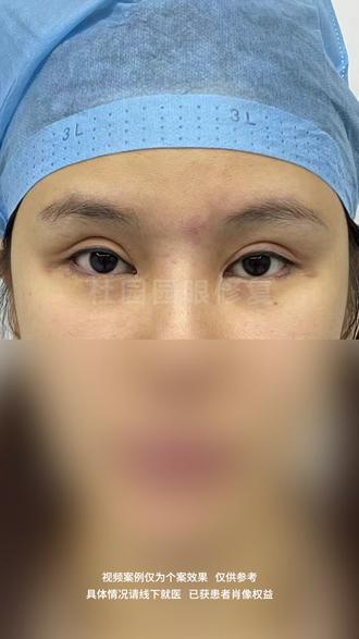 双眼皮修复改型,新月形改开扇形【上集】 #双眼皮修复 #新月形双眼皮 #开扇形双眼皮 #双眼皮假宽深 #外眼角修复