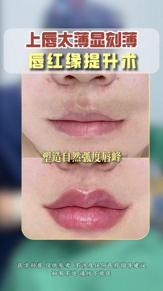 上唇太薄显刻薄,唇红缘提升术。#薄唇变厚唇 #变美 #嘴唇 #薄唇 #郑州口周整形