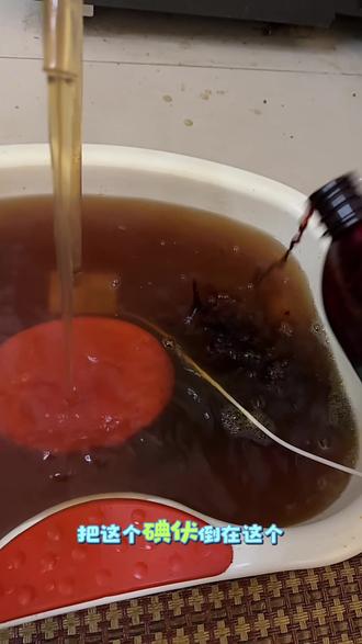 如果头上涂油比较油的 可以泡头的时候到半杯碘伏这样泡完头就不油了#银屑病 #银屑病患者 #莫离银屑病