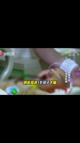 钢筋插入3岁宝宝大脑,触目惊心#真实故事 #人间百态 #纪录片