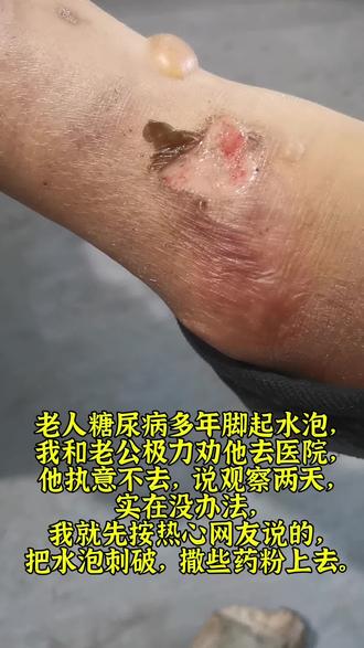 糖尿病多年脚起水泡#糖尿病#水泡