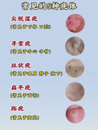 身上长小疙瘩小肉粒怎么办?教你一招在家解决#感染hpv #扁平疣 #丝状疣 #寻常疣 #脖子上的小肉粒