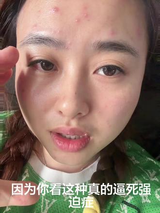 有一样的成人水痘吗?求助求助,挺急的#水痘 #成人水痘记录