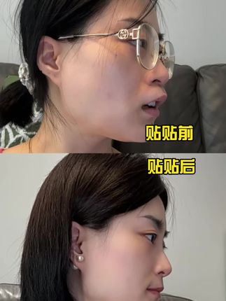 谁懂!口呼吸面容困扰了四十多年!#口呼吸贴 #测评 #亲测 #内容过于真实