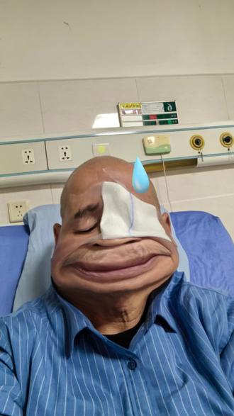 白内障治疗,新农合和社保卡均可报销100%,护工费不得报销#在医院的日子 #快点好起来 #关爱老人