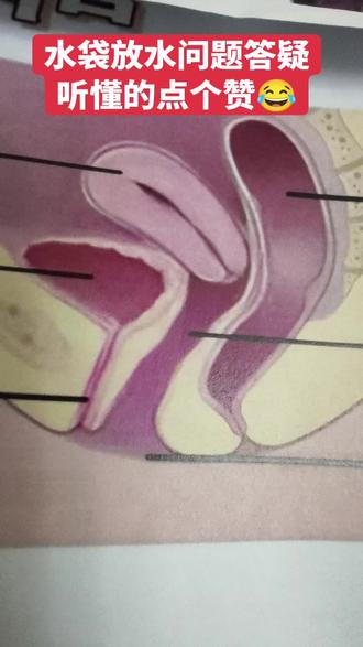 n频,n急,n不尽,用直观的通俗易懂的话给大家讲讲,希望姐妹能听懂。盆底三件套问题,看似复杂,其实就一个原因,胸廓压缩,膈肌内z下移,三件套互相挤来挤去,谁被挤变形了谁就彭了,谁被挤掉了,谁就脱垂了。#子宫脱垂 #尿不尽