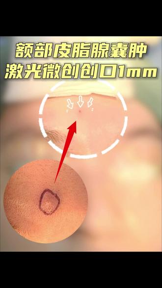 一直紧张害怕的皮脂腺囊肿,终于轻松搞定 一直紧张害怕的皮脂腺囊肿,终于轻松搞定
#皮脂腺囊肿 #皮脂腺囊肿切除 #皮脂腺囊肿微创 #安洪宾医生 #痘痘