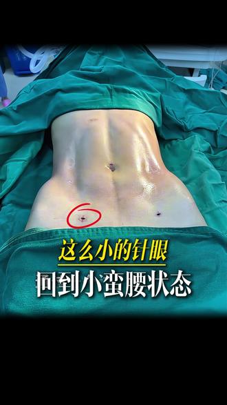 一个这么小的针眼让你回到小蛮腰的状态 #体雕 #塑形 #小蛮腰 #腰腹 #万晓楠