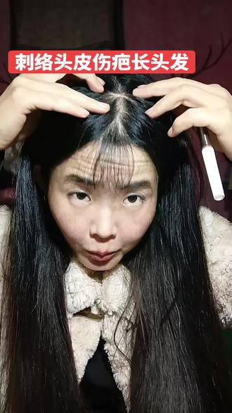 刺络头皮伤疤长头发#刺络#伤疤#长头发了