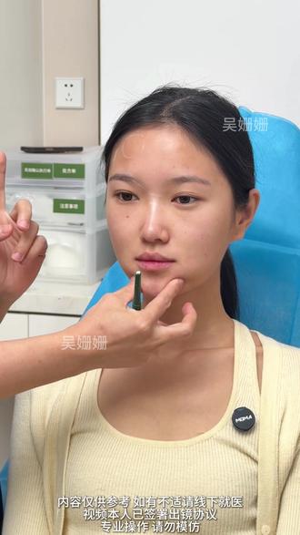 月亮脸拉出面中,做完高级感立马就有了! #注射鼻子 #韧带提升 #月亮脸 #口角支撑 #面中凹陷