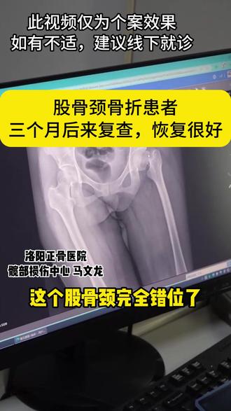 股骨颈骨折患者,三个月后来复查,恢复挺好#股骨颈骨折 #髋关节 #骨折