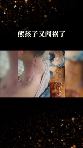 熊孩子玩烟花酿悲剧:烟花扔进小孩脖子致炸伤#烟花#炸伤