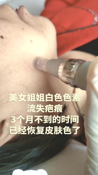 #色素疤痕 #白色疤痕 #疤痕修复前后对比 #问题性皮肤管理