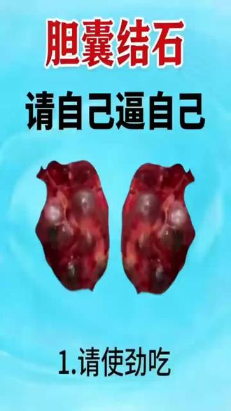 希望大家都健健康康的!#胆结石#结石