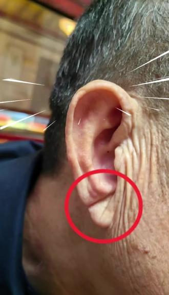 快来看看自己的耳朵,家人的耳朵上有没有这条沟吧!