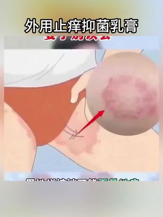 大腿内侧有问题的请看这里 #好物分享 #日常知识分享 #股癣 #脚气 #湿疹