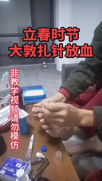 立春时节,大敦穴针灸或放血,有益健康#自学中医 #立春 #倪海厦老师讲中医 #我要上热门🔥
