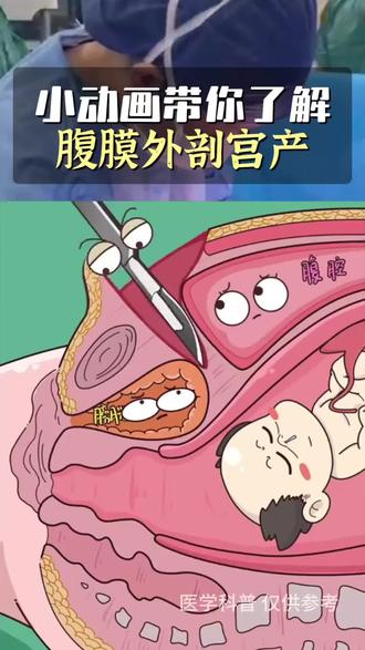 带你一起了解明星最追捧的生孩子方式!#明星同款 #健康科普 #腹膜外剖宫产 #生孩子