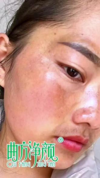 9D黑科技!祛斑就是这么牛!尤其针对黄褐斑