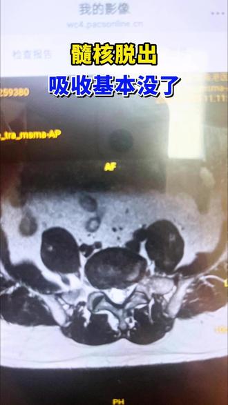 髓核脱出吸收基本没了 #髓核脱出 #腰椎间盘突出 #腰椎管狭窄 #康复