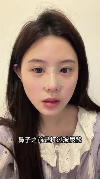 很多宝宝说我基础挺好的为啥还要做肋骨鼻,统一给大家解答一下~ 因为我之前打过啵啵和濡白,所以整体看起来不算太差,但是有回落和变宽,所以想要长期效果还是得做肋骨鼻,这次做的相对自然,还带了点点微起伏!
#肋骨鼻 #隆鼻 #做鼻子后有多疼 #原相机 #变美逆袭