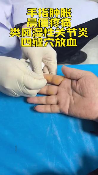 手指肿胀,晨僵疼痛,类风湿性关节炎,四缝穴放血#类风湿关节炎 #晨僵 #医学科普知识