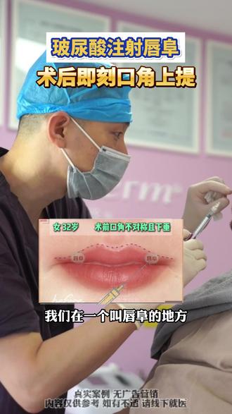 玻尿酸注射丰唇 #丰唇 #口角上提 #口角上扬
