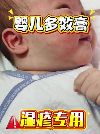 湿疹老是困扰宝宝?皮肤发红发痒? 湿疹老是困扰宝宝?皮肤发红发痒?红屁屁?这款婴儿平安膏都能高效改善!#宝宝湿疹怎么办 #宝宝湿疹面霜 #红屁屁克星