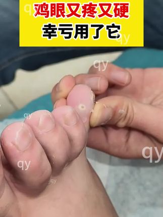 鸡眼又疼又深,幸好用了它#鸡眼#鸡眼跖疣 #鸡眼膏 #鸡眼去除小妙招 #老茧