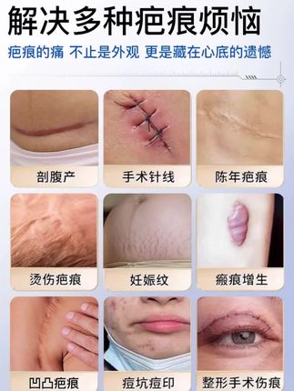 修正酵母重组Ⅲ型人源化胶原蛋白疤痕凝胶皮肤病理性疤痕的形成烧烫伤创伤或手术造成的皮肤疤痕#祛疤膏 #疤痕凝胶 #祛疤痕产品推荐 #好物分亨 #祛疤痕