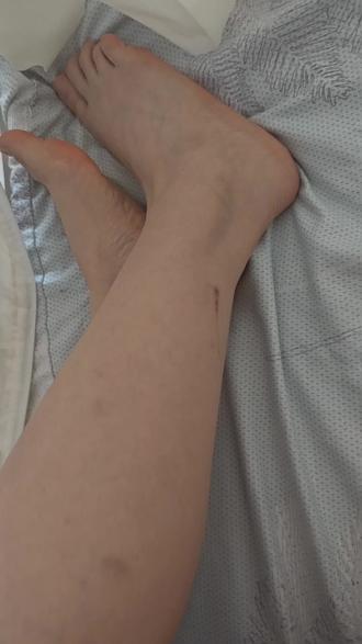 问一下你们的腿也会经常青一块紫一块吗?反正长年我的腿都会这青一块那紫一块,也不知道到底是碰到哪了磕到哪了#受伤的小腿腿