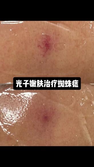 血管消失术:强脉冲光(光子嫩肤)治疗蜘蛛痣及血管扩张#光子嫩肤 #血管扩张