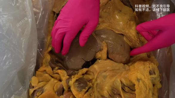 看完这个视频,你还敢天天喝奶茶吗?#喝奶茶的危害 #科普知识 #科普健康知识 #奶茶一杯快乐加倍 #女生必看