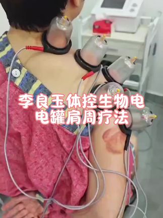 电罐肩周电疗法#体控电疗培训 #生物电