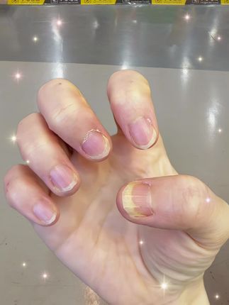 #日常分享 #看过来 #灰指甲 #强烈推荐 #上岸