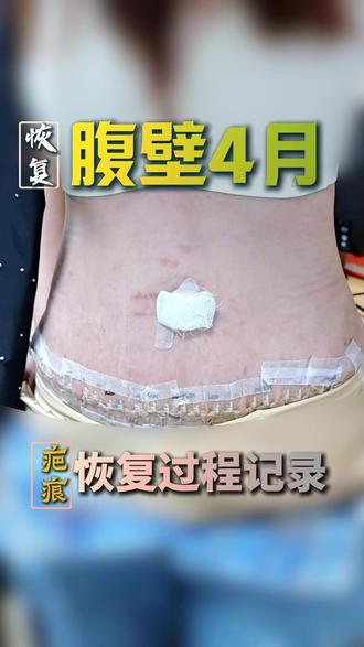 腹壁整形术后4个月疤痕恢复情况 #腹壁整形 #腹壁成形夏学颖 #疤痕 #恢复