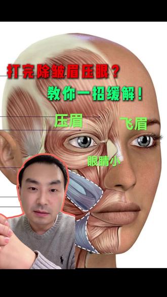 打完除皱眉压眼?教你一招缓解! #肉毒素 #除皱 #压眉 #整形医生胡亮