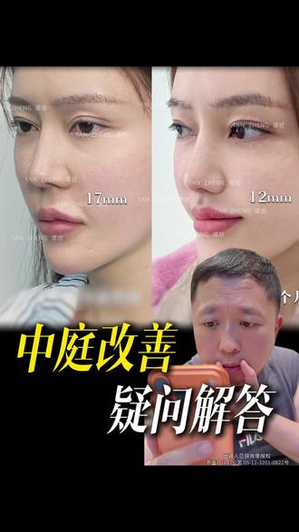 跟我一样 口周太长的姐妹看过来‼️
#水滴窝 #c翘型人中 #中庭长 #人中缩短对比 #口周年轻化