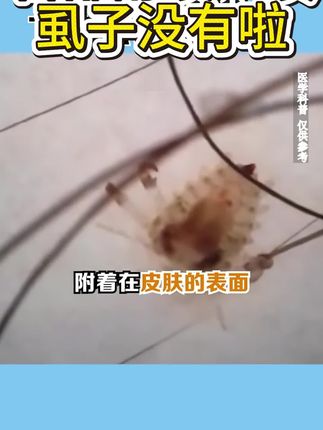 仁和药业百部酊喷雾剂男女阴用成人祛除虱子虱卵虱立净一扫光正品#长虱子怎么消除 #消除虱子卵的小妙招 #身上长虱子怎么消除 #草本植物 #百部酊喷剂
