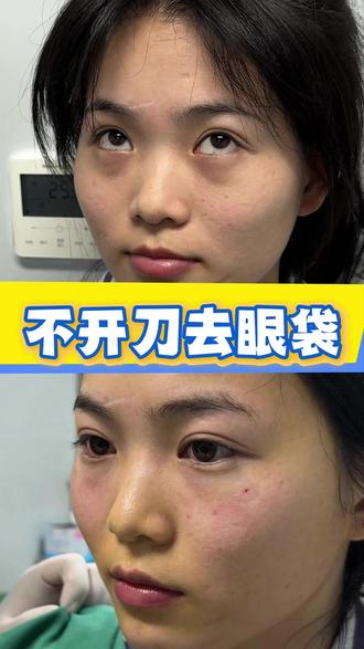 不开刀去眼袋 #去眼袋 #不开刀去眼袋