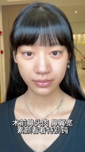 我的缩鼻过程分享#缩鼻翼#缩鼻头#鼻翼缩小#徐丽芬#大鼻子