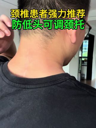 颈椎术后患者给你分享,夏天专用的颈托。 1️⃣第一能够支撑头部重力,减小你颈椎上的压力;第二能防低头,在你低头看手机看电脑时候防止过度长时间低头。 2️⃣每天佩戴1-2小时,脖子不舒服时候戴、长时间低头时候戴。 3️⃣高度可调、三个尺码;夏天专用、透气孔又多又大。 #夏天颈托 #颈托 #防低头颈托 #护颈脖套