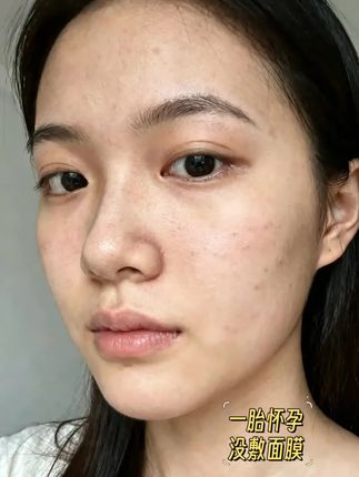 怀孕后皮肤干燥缺水,一定要试试这款袋鼠妈妈补水面膜,成分温和,保湿补水,敷完皮肤很水润,毛孔都隐形了,还能用它来对付孕期肌肤松弛的问题呢。 这款孕期产后都可以用,日常的补水效果不错,对敏感肌也超级友好!#一个身体两个心跳 #孕妈 #护肤好物好用不贵 #袋鼠妈妈
