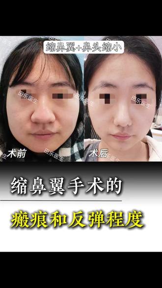 缩鼻翼手术的瘢痕和反弹程度,听听真实反馈吧! #缩鼻翼 #鼻头缩小 #鼻翼缩小 #八大处田乐