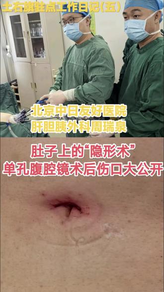 肚子上的“隐形手术”——单孔腹腔镜技术 #健康知识科普 #医学科普健康 #记录医生工作的日常 #科普健康知识 #微创手术切口