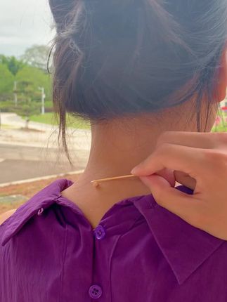 #点痣祛疣 #脖子上的小肉粒怎么祛除