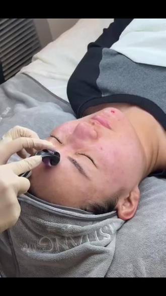 三文鱼水光收缩毛孔,祛痘痘痘印滚针操作❤️